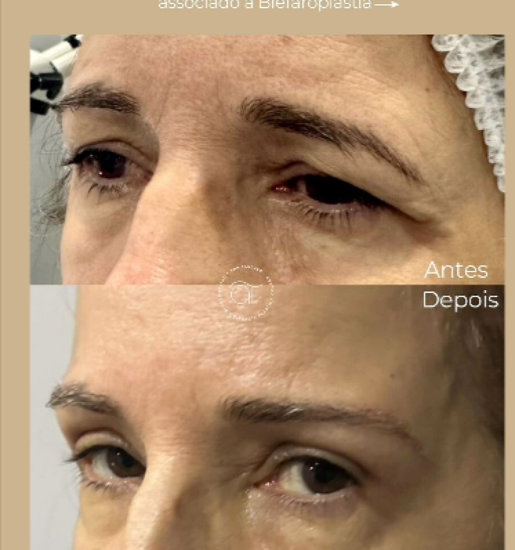 cirurgia ocular em maceió - al